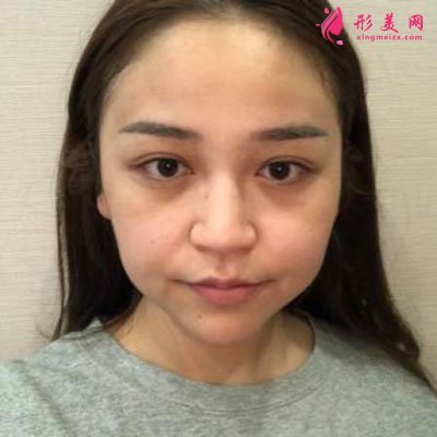 杭州瑞麗整形美容醫(yī)院隆鼻案例