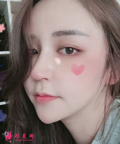 杭州瑞麗整形美容醫(yī)院隆鼻案例