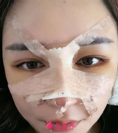杭州瑞麗整形美容醫(yī)院隆鼻案例