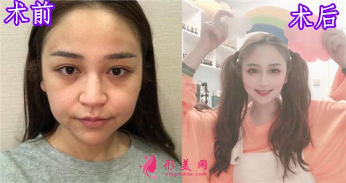 杭州瑞麗整形美容醫(yī)院隆鼻案例