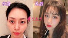 蘇州美貝爾做自體脂肪面部填充效果怎么樣？案例|對比圖|價(jià)格