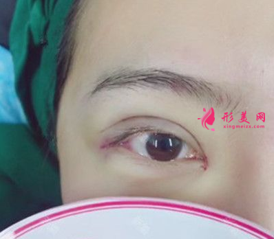 找上海美聯(lián)臣李炅默做的雙眼皮 40天術(shù)后效果恢復(fù)得簡(jiǎn)直太好了