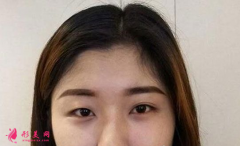 上海美聯(lián)臣做的雙眼皮 40天術(shù)后效果恢復(fù)得簡(jiǎn)直太好了