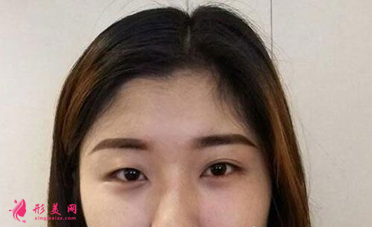 找上海美聯(lián)臣李炅默做的雙眼皮 40天術(shù)后效果恢復(fù)得簡(jiǎn)直太好了