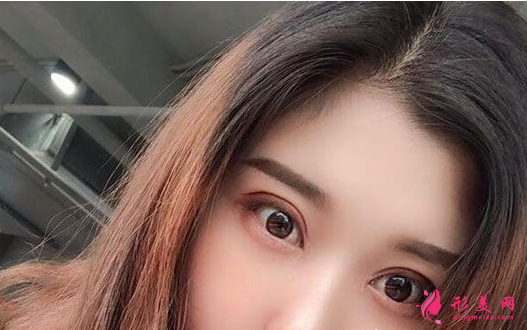 找上海美聯(lián)臣李炅默做的雙眼皮 40天術(shù)后效果恢復(fù)得簡(jiǎn)直太好了