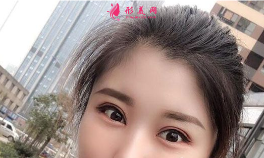 找上海美聯(lián)臣李炅默做的雙眼皮 40天術(shù)后效果恢復(fù)得簡(jiǎn)直太好了