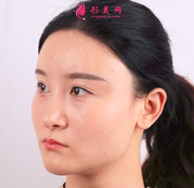 上海華美醫(yī)療美容醫(yī)院V-LINE瓜子臉手術(shù)案例