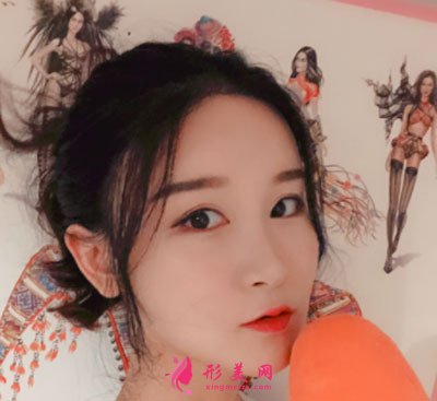 上海華美醫(yī)療美容醫(yī)院V-LINE瓜子臉手術(shù)案例