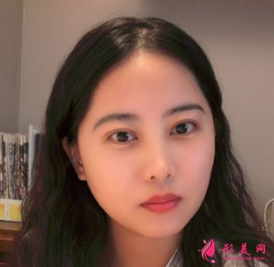 廈門美萊醫(yī)療美容醫(yī)院眼部多項(xiàng)案例