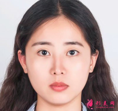 廈門美萊醫(yī)療美容醫(yī)院眼部多項(xiàng)案例