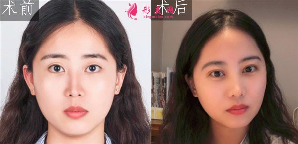 廈門美萊醫(yī)療美容醫(yī)院眼部多項(xiàng)案例