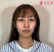寧波靜港整形自體脂肪面部填充真人案例來了，術(shù)前術(shù)后對(duì)比圖分享