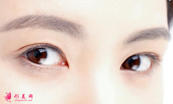 切開雙眼皮的恢復(fù)時(shí)間長嗎