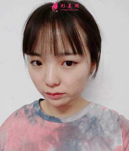 青島市中心醫(yī)院整形美容科做雙眼皮案例分享