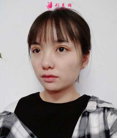 青島市中心醫(yī)院整形美容科做雙眼皮案例分享