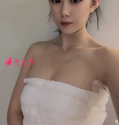 成都美萊醫(yī)院吳江山為我做的假體隆胸手術(shù)后
