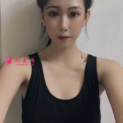 成都美萊醫(yī)院吳江山為我做的假體隆胸手術(shù)前