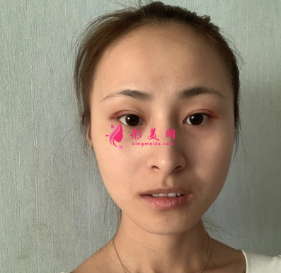 云想月醫(yī)療美容醫(yī)院雙眼皮術后7天