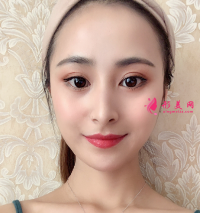 術后33天雙眼皮效果圖片