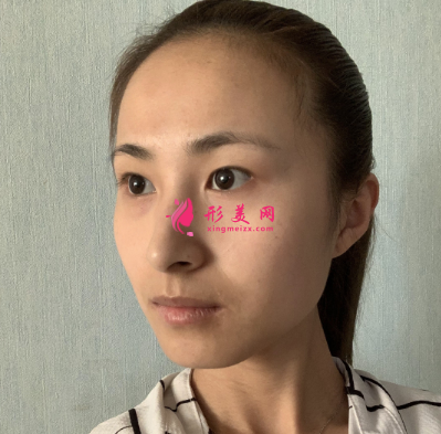 術前照片
