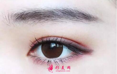 切開雙眼皮老了會(huì)消失嗎