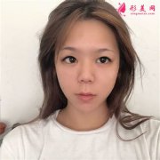 鄭州大學(xué)第二附屬醫(yī)院切開雙眼皮手術(shù)術(shù)后恢復(fù)情況對(duì)比