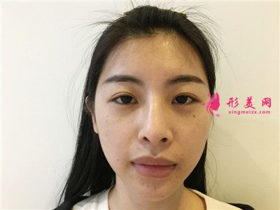 廣州M唇術(shù)后恢復(fù)情況分享