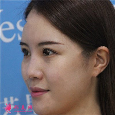 濟南鼻綜合術(shù)后恢復(fù)情況分享