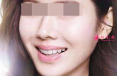 自體脂肪填充臉部一般多少錢(qián)？