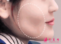 自體脂肪填充臉部的恢復(fù)期