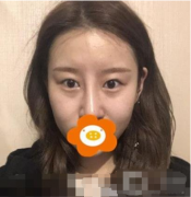 上海華美割雙眼皮2021全新價(jià)格表和案例分享