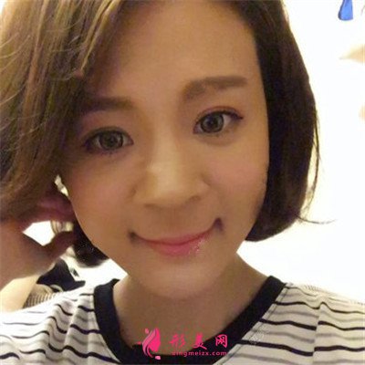 深圳鼻綜合手術(shù)術(shù)后恢復(fù)情況對比