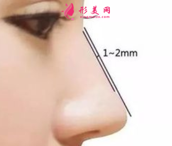 自體軟骨隆鼻恢復(fù)期長(zhǎng)嗎