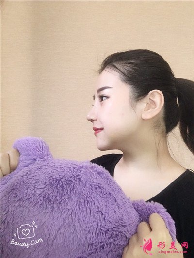 鄭州自體肋軟骨隆鼻術后恢復效果展示