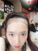 成都恒博發(fā)際線(xiàn)調(diào)整術(shù)后恢復(fù)情況反饋