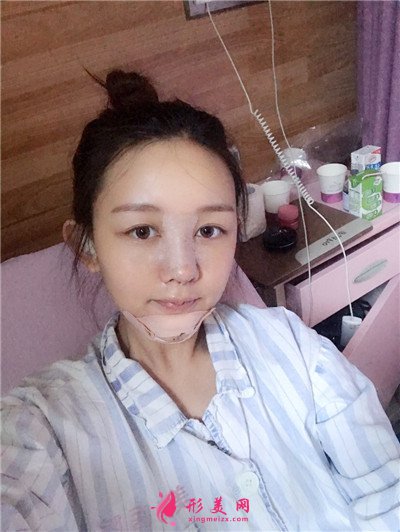 鄭州小仙女鼻綜合術(shù)后效果圖分享