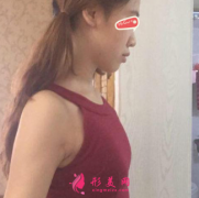 昆明星耀整形醫(yī)院假體隆胸蛻變?nèi)沼?，效果真不錯，大胸好性感