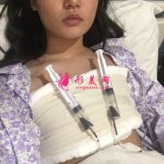 北京京民整形外科假體隆胸案例 性感迷人 告別“飛機(jī)場”