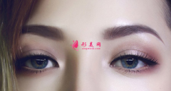 全切雙眼皮什么時(shí)候拆線比較好