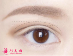 雙眼皮術(shù)后需要做好的護(hù)理工作
