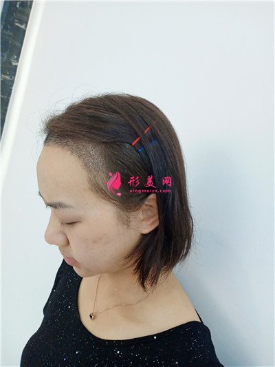 成都植發(fā)際線手術(shù)1900單位術(shù)后頭發(fā)生長(zhǎng)情況對(duì)比