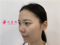 廣州可玉醫(yī)療美容小姐姐面部線雕提升術(shù)后效果分享