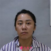 長沙亞韓美容整形醫(yī)院祛眼袋術(shù)后恢復(fù)效果反饋