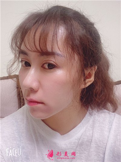 青島祛眼袋術后恢復效果反饋