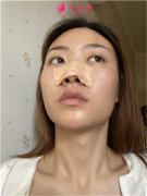 武漢恩吉娜醫(yī)療美容醫(yī)院硅膠假體隆鼻術(shù)后恢復(fù)情況分享