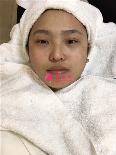河南激光祛斑術(shù)后效果反饋