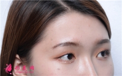 杭州維多利亞醫(yī)療美容醫(yī)院切開(kāi)雙眼皮術(shù)后恢復(fù)情況反饋