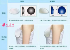 隆胸假體型號(hào)哪種比較好？