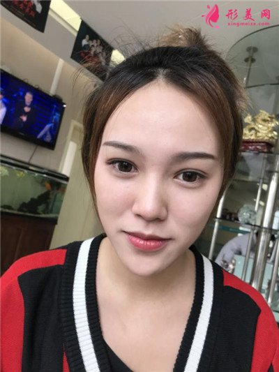 成都小姐姐自體肋軟骨隆鼻術(shù)后效果展示