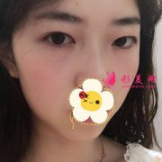 北京彤美醫(yī)療美容醫(yī)院切開雙眼皮案例 線條很流暢 告別內(nèi)雙